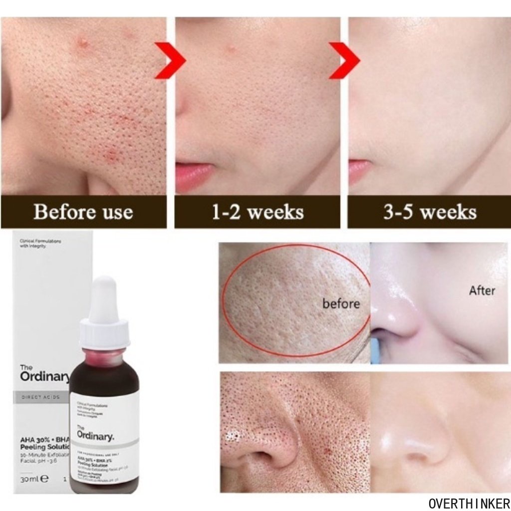 Original Ready Stock The Ordinary 30% AH-A + B-HA 2%
