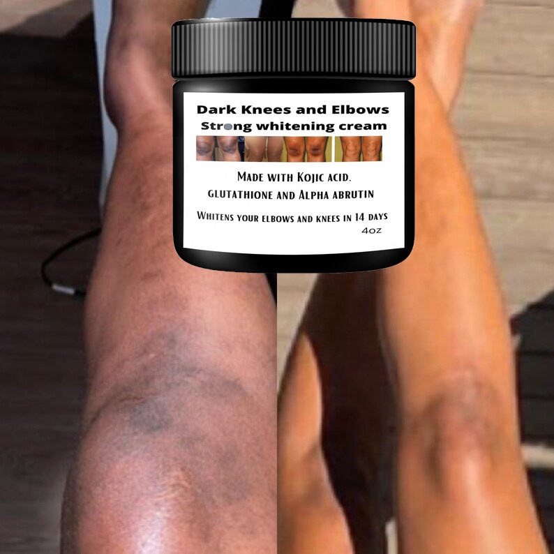Dark Knees and Elbows Strong Whitening Cream Fast 