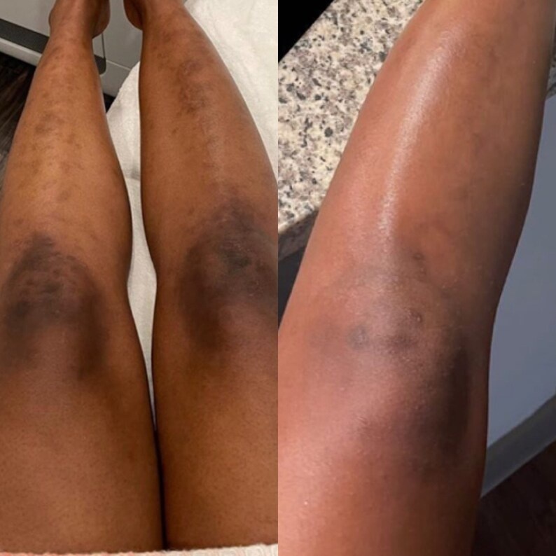 Dark Knees and Elbows Strong Whitening Cream Fast 