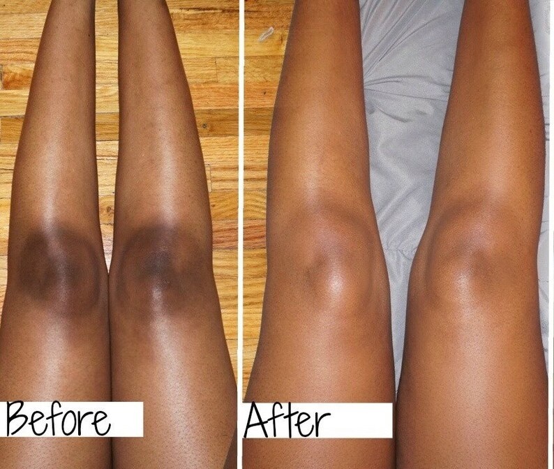 Dark Knees and Elbows Strong Whitening Cream Fast 