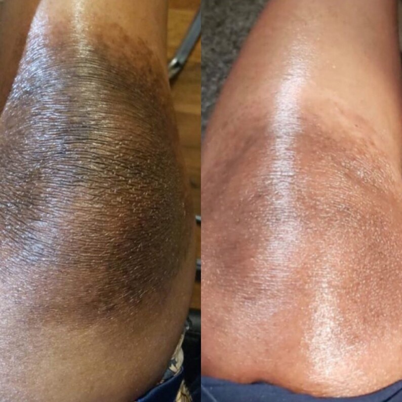 Dark Knees and Elbows Strong Whitening Cream Fast 