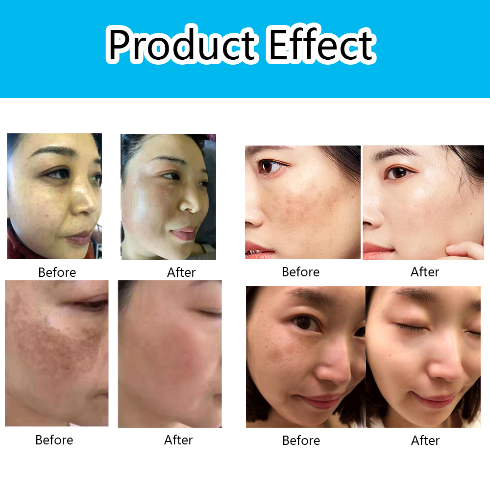 Skin Care Whitening Dark Spot Freckle Removal S-pretty King Serum For Face