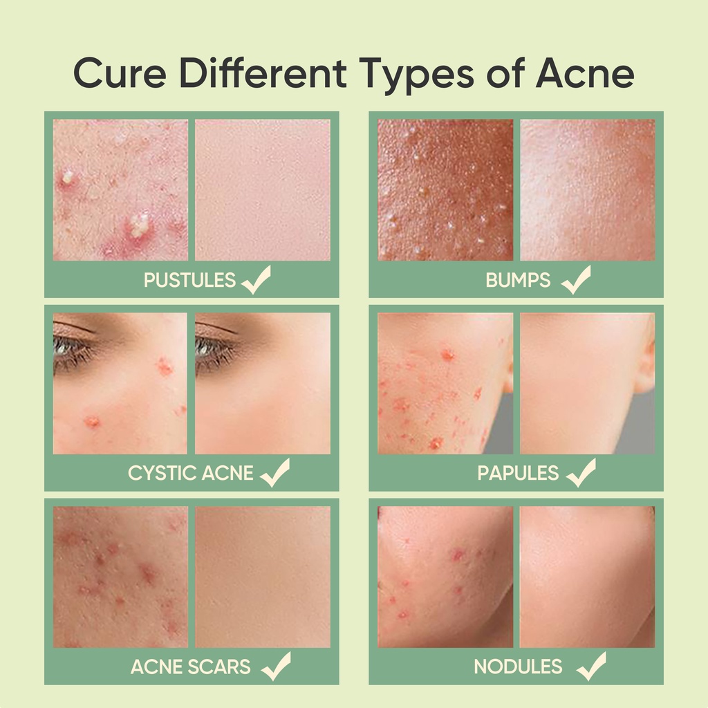 [READY STOCK] SKINTIFIC Salicylic Acid Anti Acne Spot Treatment (10g)