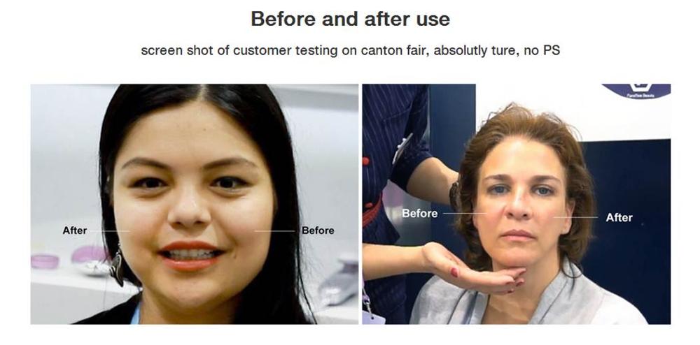 ems rf facial galvanic rejuvenation beauty smart l