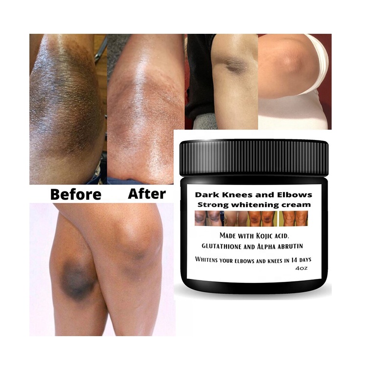 Dark Knees and Elbows Strong Whitening Cream Fast 